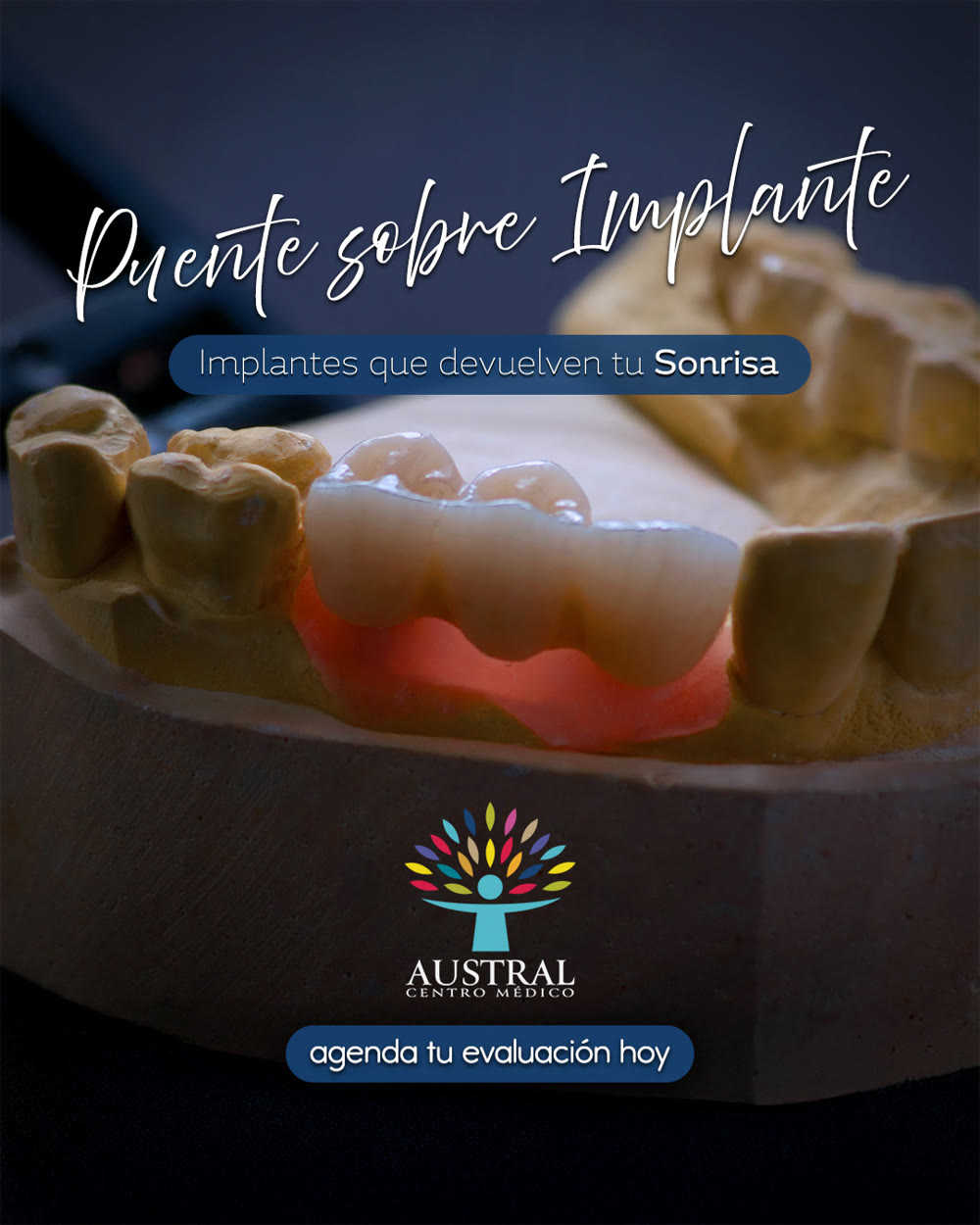 Puente sobre implante dental realizado en Centro Médico Austral
